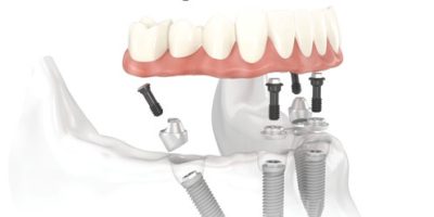 Icon style image for blog: Have new teeth in a day with All-on-4 dental implants in Cheltenham