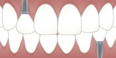 Icon style image for blog: Dental implants: the go-to solution for restoring missing teeth