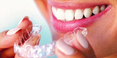 Icon style image for blog: More than straight teeth – benefits of braces in Cheltenham