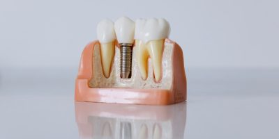 Icon style image for blog: Get your teeth back with dental implants