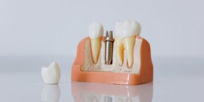 Icon style image for blog: Why we love dental implants in Cheltenham