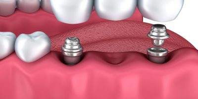 Icon style image for blog: The lowdown on dental implants in Cheltenham