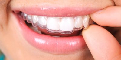 Icon style image for blog: Different types of cosmetic braces in Cheltenham